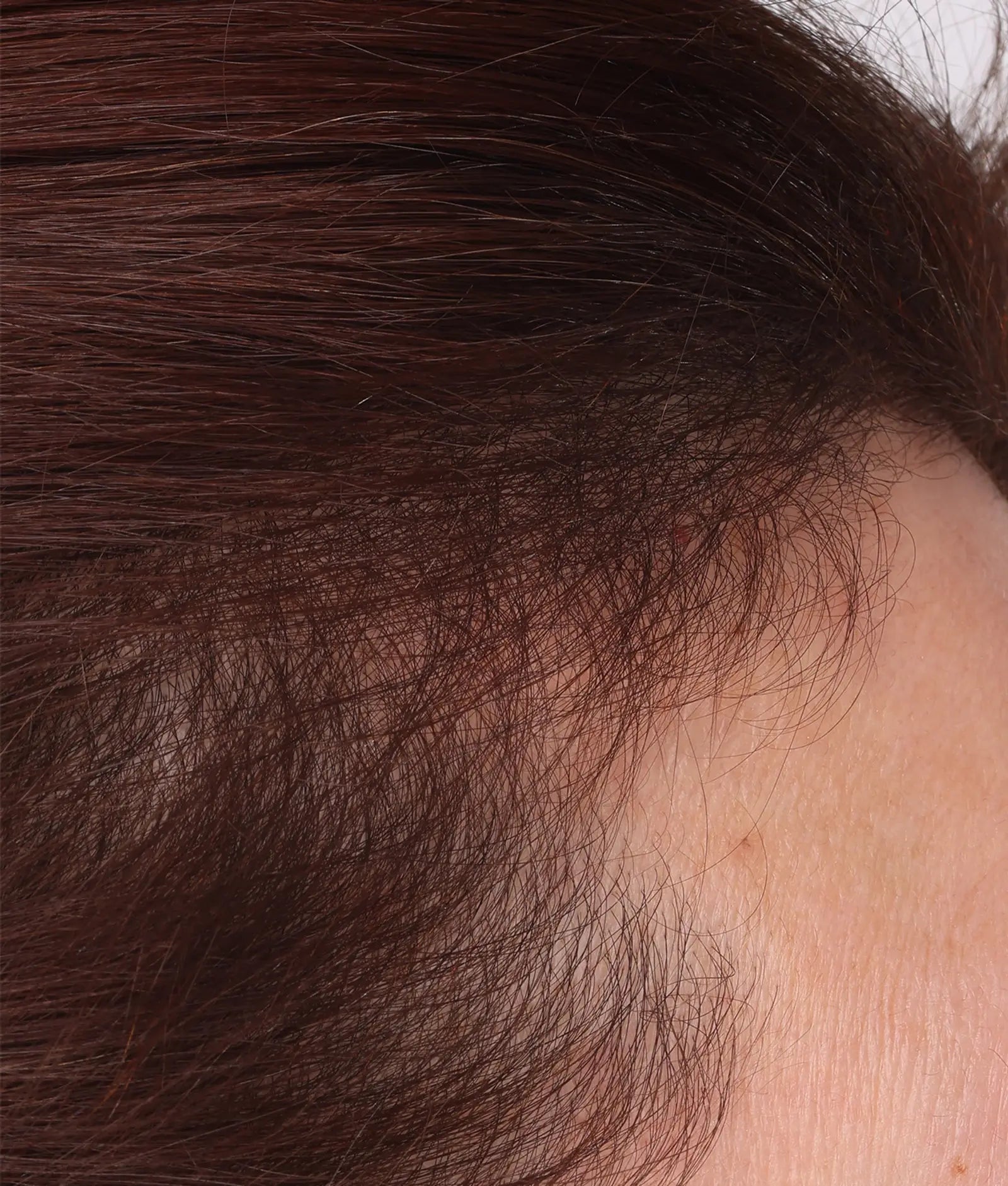 Close-up of scalp and dark brown hair texture along the hairline